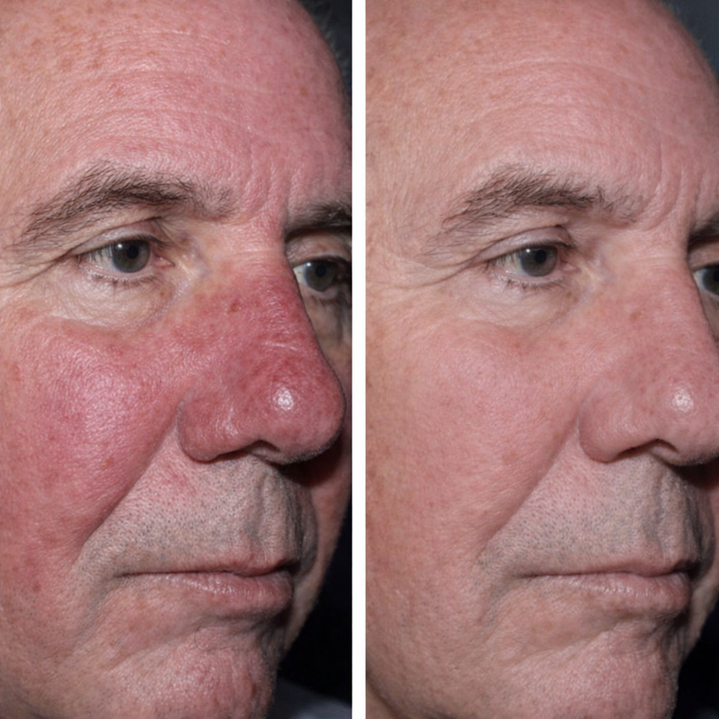 Before and After result